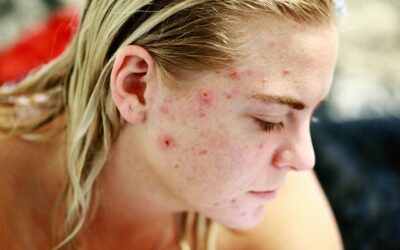 Problèmes d’acné:comment réussir à s’en débarrasser assez facilement?